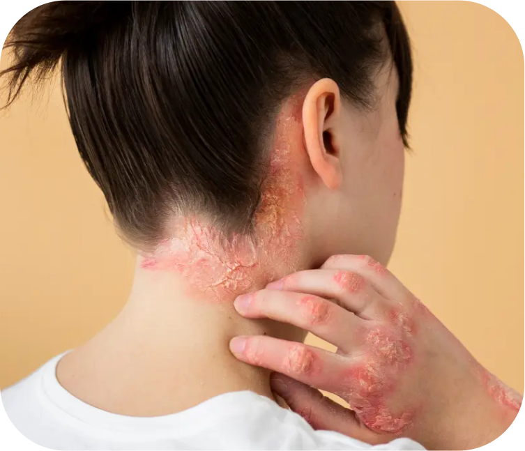 Skin Fungal Disease Treatment