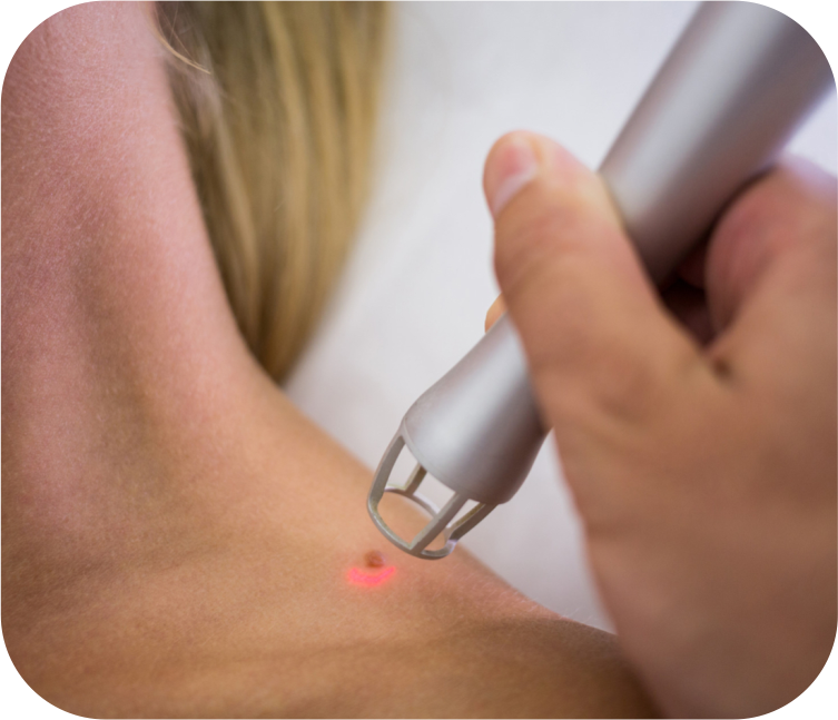 Mole, Skin Tag & Wart Removal Treatment Process