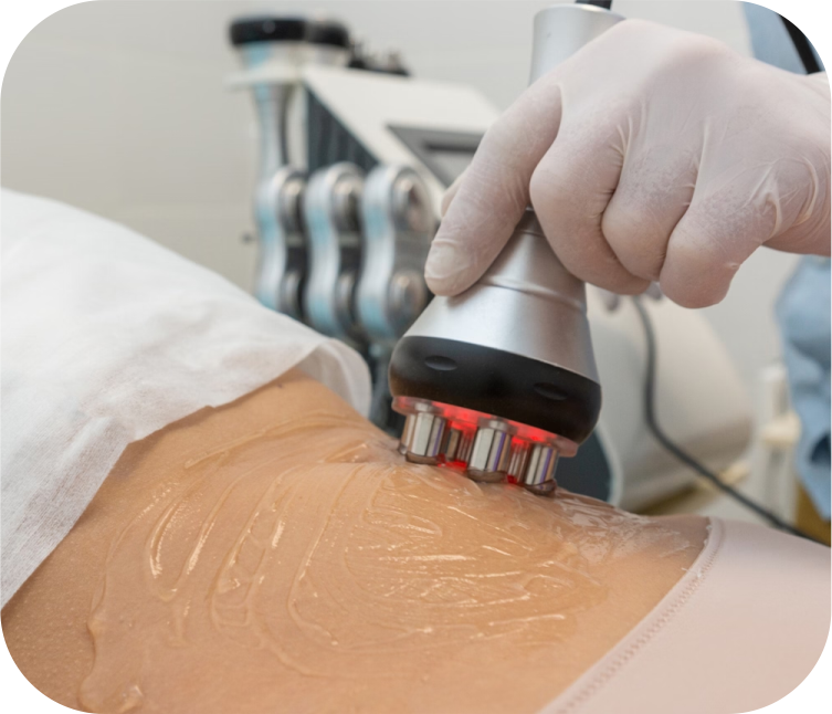 RF Skin Tightening Treatment Process