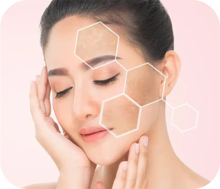 Melasma Acne Freckles Treatment