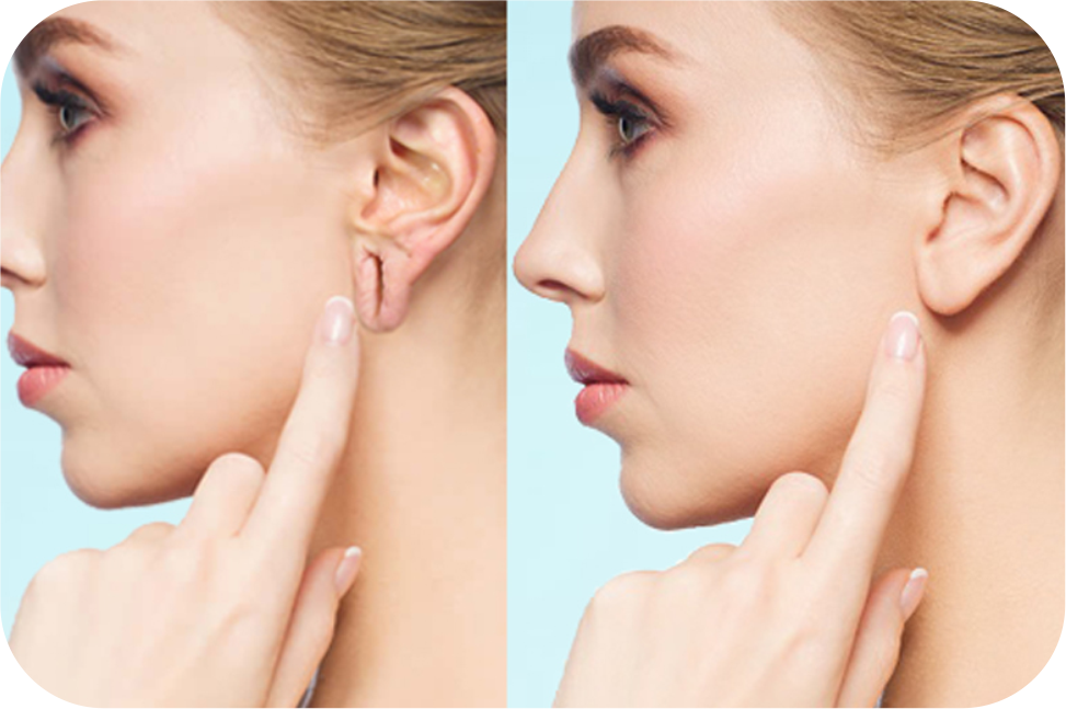 Earlobe Repair Treatment