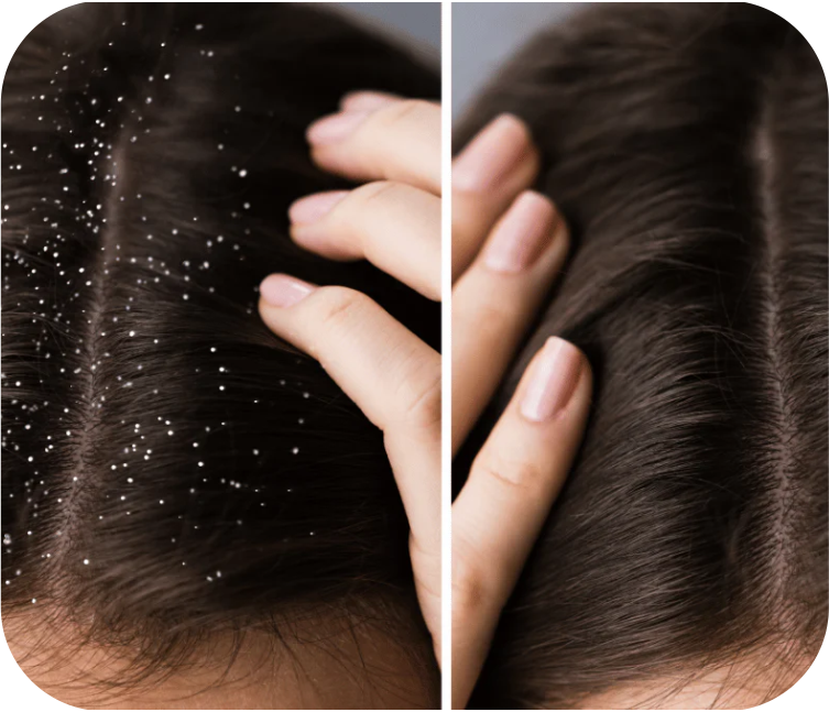 Dandruff Removal Treatment