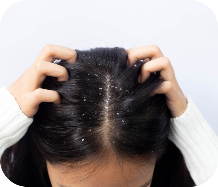What Causes Dandruff