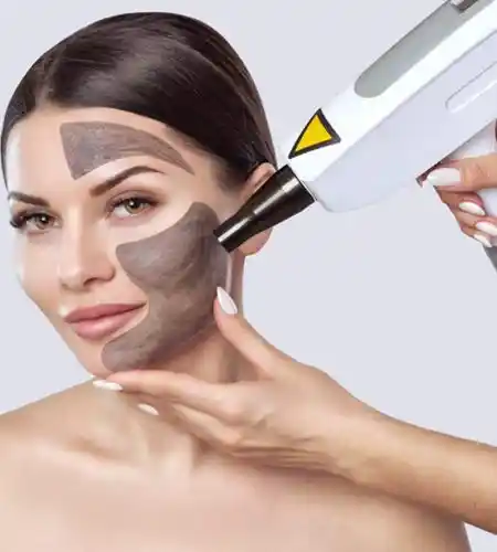 Carbon Peel (Hollywood Facial)